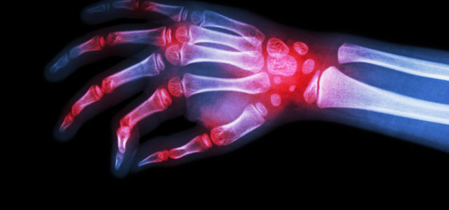 Experiencing Pain from Rheumatoid Arthritis?