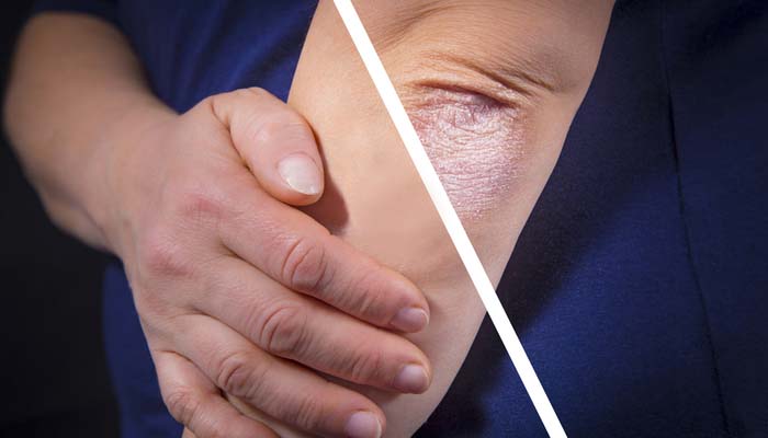 Best Psoriasis Treatment Options