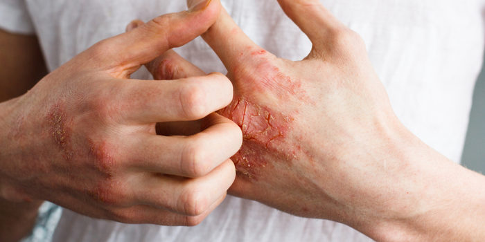 Eczema: Symptoms, Causes and Treatments