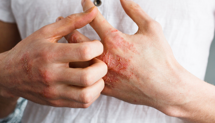 Eczema: Symptoms, Causes and Treatments
