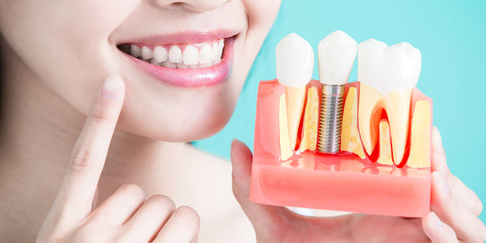 Dental Implants: Everything You Need to Know