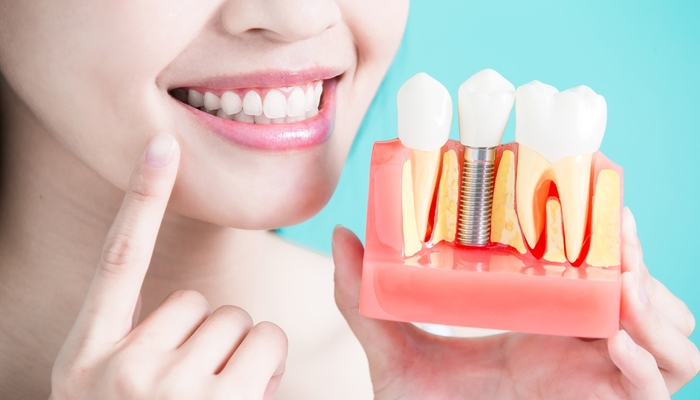 Dental Implants: Everything You Need to Know